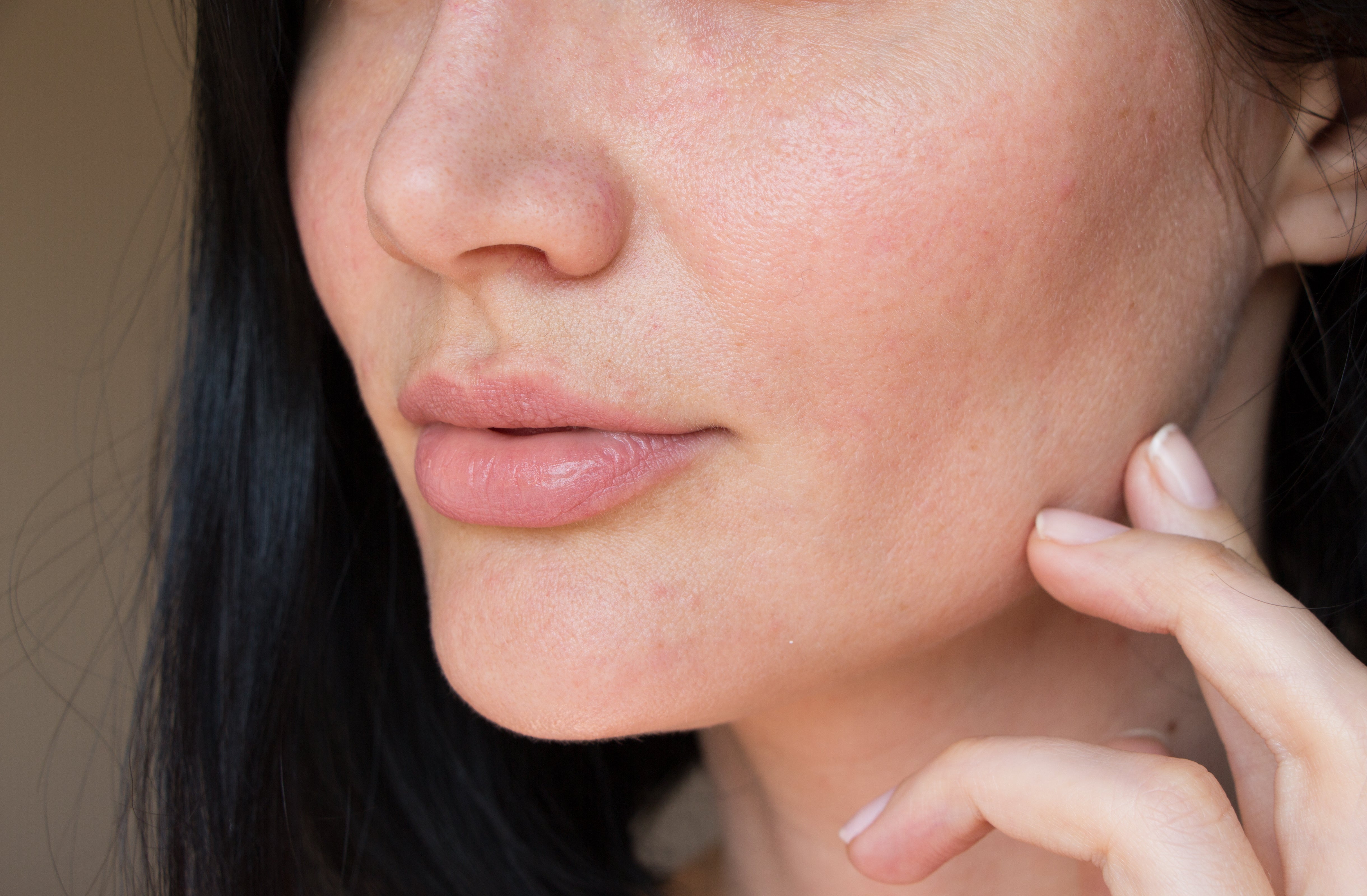 5 Winter Skin Issues & How To Solve Them